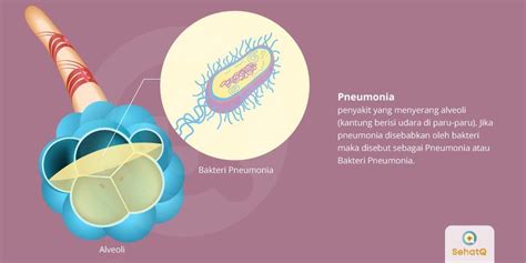 Bakteri Pneumonia Tanda Dan Gejala Penyebab Cara Mengobati Cara Hot
