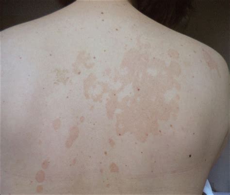 Everything You Need To Know About Tinea Versicolor Ti