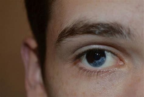 I Was Born With Sectoral Heterochromia Although Its Rare R