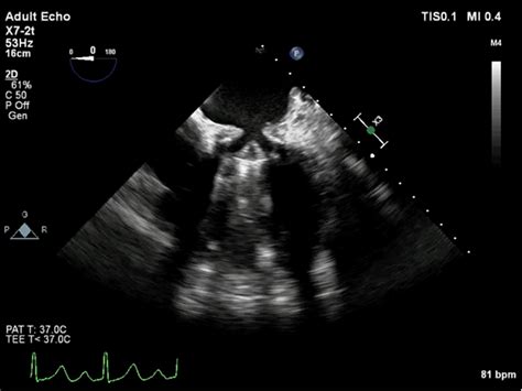A Funnel Shaped Pannus Formation Above The Mitral Prosthetic Valve