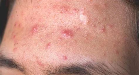 How Do Pimples Form Causes Types And More