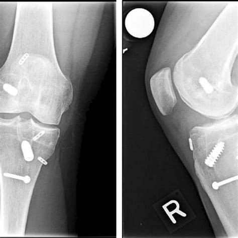 Knee X Rays With Ap View Left And Lateral View Right Taken At 17