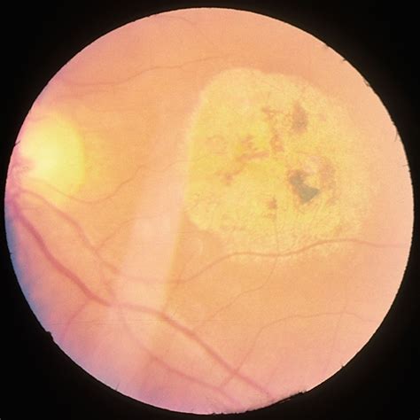 Macular Atrophy Retina Image Bank