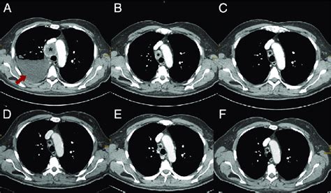 A Baseline Ct Scan Prior To Nivolumab Therapy Showing A Large