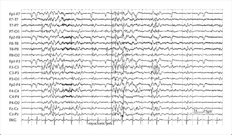 Eeg During The Myoclonic Status Epilepticus Before The Administration