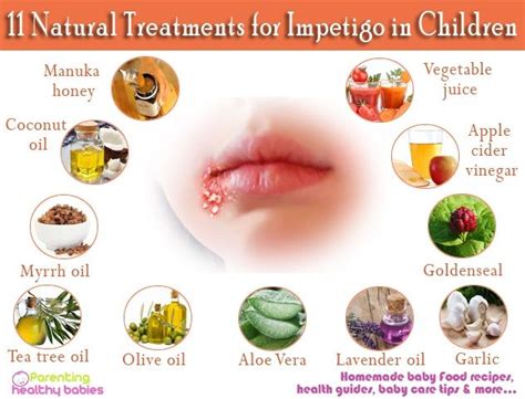 11 Natural Treatments For Impetigo In Children Impetigo Natural