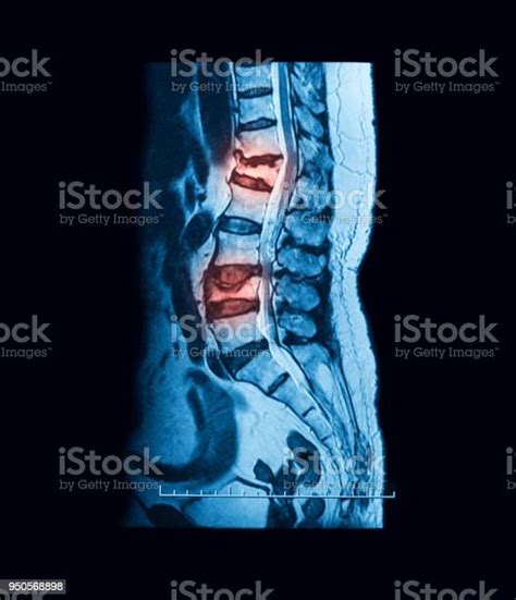 Mri Scan Of Lumbosacral Spine Sagittal View Stock Photo Download