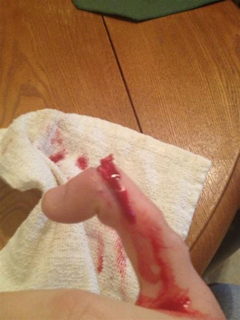 The ankle bones are just the bottom ends of the two bones in the lower leg, called the tibia and fibula. Rob on Twitter: "Broke my finger. And my bones sticking ...