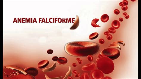 A Anemia Falciforme Análises Clí