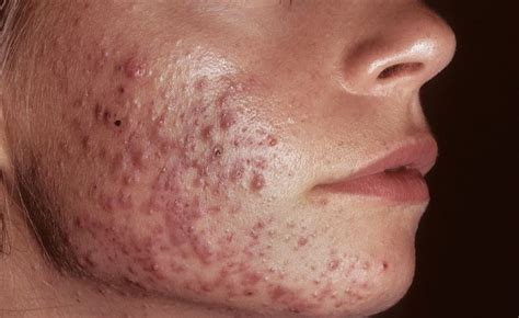 Amoxicillin Therapy Effective For Treating Inflammatory Acne