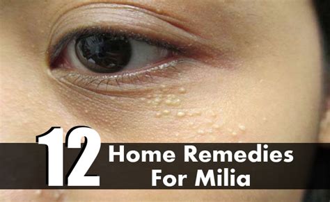 12 Easy Diy Home Remedies For Milia Morpheme Remedies India