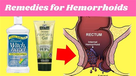 4 Home Remedies For Hemorrhoids Hemorrhoid No More Youtube