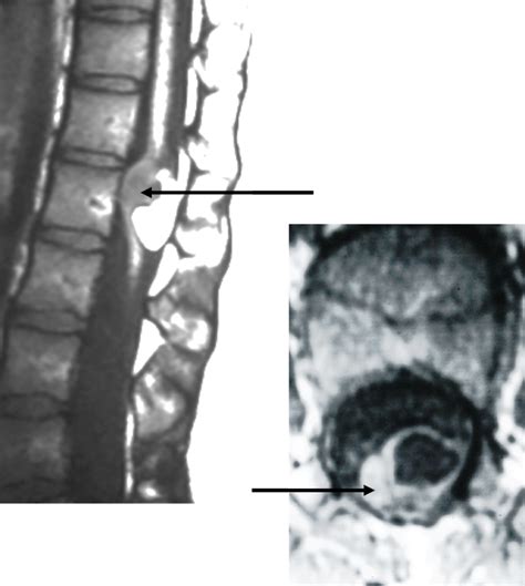 Cureus Comprehensive Review Of Spinal Neurenteric Cysts With A Focus