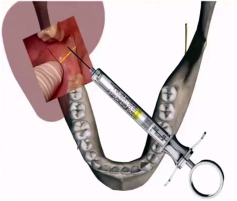 Anestesia Dental Bloqueo Del Nervio Dentario Inferior Anestesia