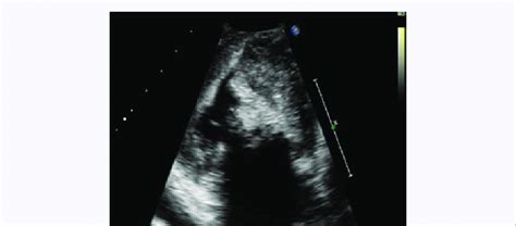 Echocardiography Showing The Mass Protruding Through The Left