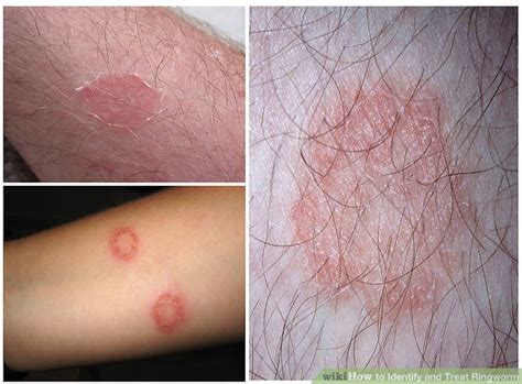 How To Identify And Treat Ringworm Skin Conditions Tips Wiki English