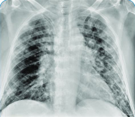 Chest Radiograph At Admission Demonstrating Diffuse Bilateral