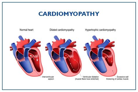 Prevention And Treatment Of Cardiomyopathy Consult Best Doctor