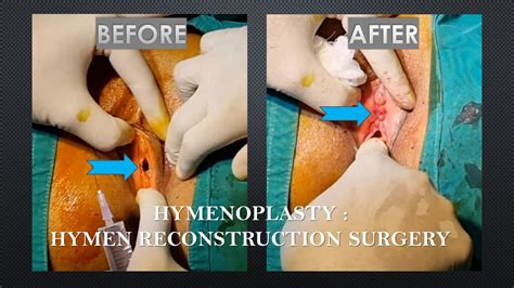 hymenoplasty before and after