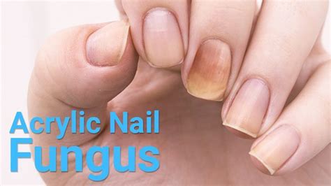Know How Nail Fungus Occur With Artificial Acrylic Nails And How To Get