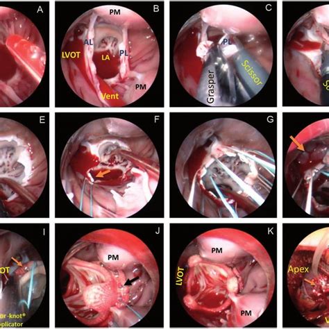 Steps For Transapical Cardioscopic Mitral Valve Replacement A Setup