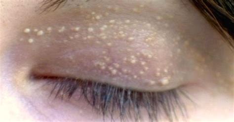Strange Bumps Affect Millions But Treating Them Is As Simple As Rubbing