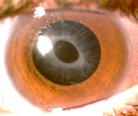 Anterior Capsular Cataract