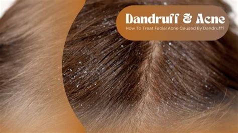 Does Dandruff Cause Acne Relationship And Treatment