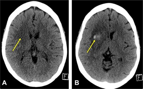 Hemorrhagic Transformation Of Cerebral Infarct Radiology Cases