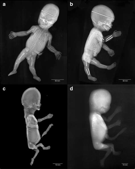 Examples Of Fetal Biometric And Long Bone Lengths Taken Using