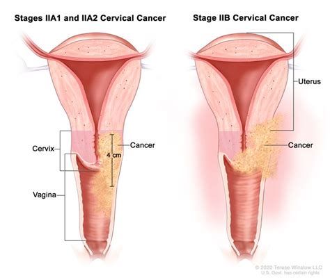 Cervical Cancer Treatment Pdq®patient Version Siteman Cancer Center