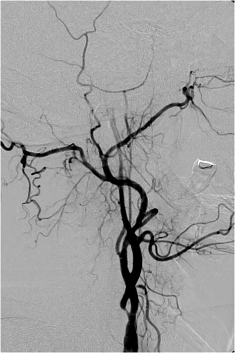 Right Carotid Angiogram Showing Severe Internal Carotid Artery Stenosis