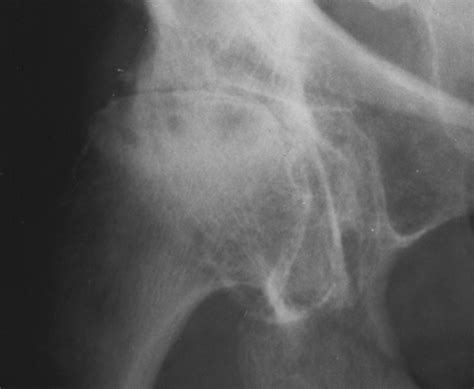 Rapidly Destructive Osteoarthritis Of The Hip Mr Imaging Findings Ajr