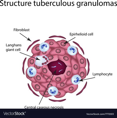 The Structure Tuberculous Granulomas Royalty Free Vector