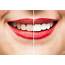 Professional Teeth Whitening From Your Dentist  Marietta GA