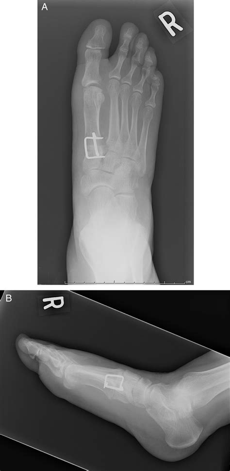 The Incidence Of Nonunion After Lapidus Arthrodesis Using Staple