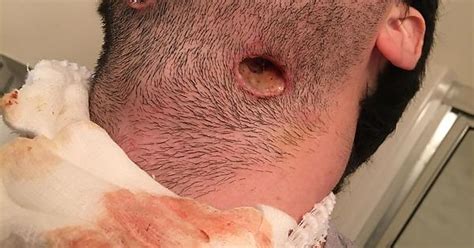 Man Gets 2 Gaping Holes In The Neck After Wisdom Tooth Surgery Imgur