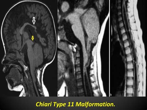 Radiological Findings Of Congenital Anomalies Of The Spine And Spinal