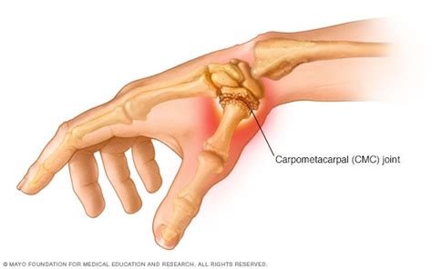 Artritis Del Pulgar S Ntomas Y Causas Mayo Clinic