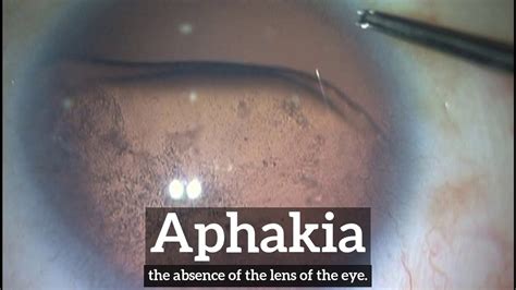 What Is Aphakia How Does Aphakia Look How To Say Aphakia In