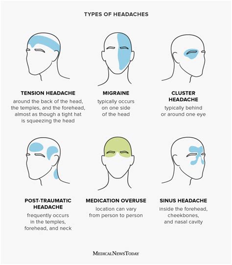 5 Types Of Headaches And The Best Ways To Get Rid Them Bright Side
