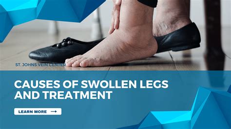 Causes Of Swollen Legs And Treatment St Johns Vein Center