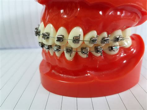 Silver Self Ligating Dental Braces Rs 2500 Box Doctors Choice Id