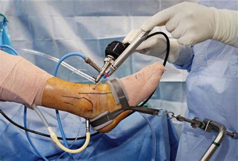 If someone has a club foot , they are born with a badly twisted foot. وحدة جراحة القدم والكاحل | تصحيح انحراف الاصبع الكبير ...