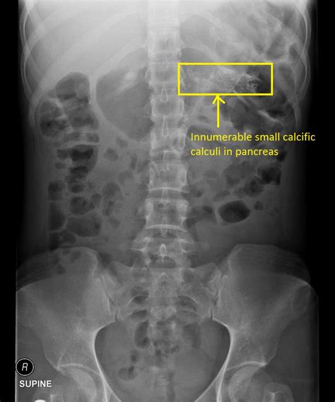 Chronic Pancreatitis Abdominal X Ray Wikidoc