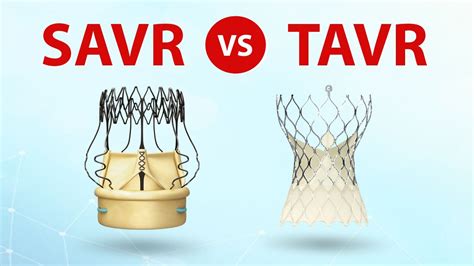 Savr Vs Tavr Patient Webinar What Should Patients Know Youtube