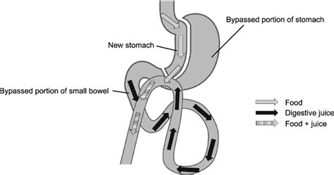 Schematic Diagram Of The Laparoscopic Mini Gastric Bypass Procedure Download Scientific Diagram