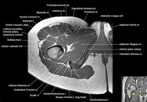 Axial Hip Mri Anatomy