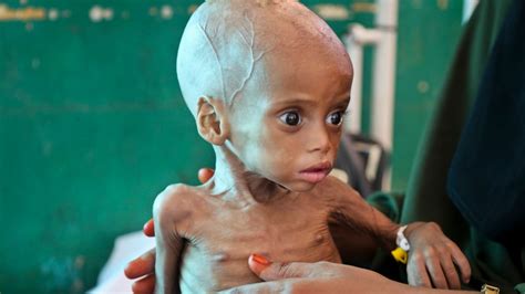 Somali Children Dying Of Starvation Unicef