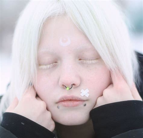 521 Best Images About Albinism Vitiligo On Pinterest